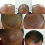 Best Hair Transplant in Hyderabad [351+ Successful Treatments]