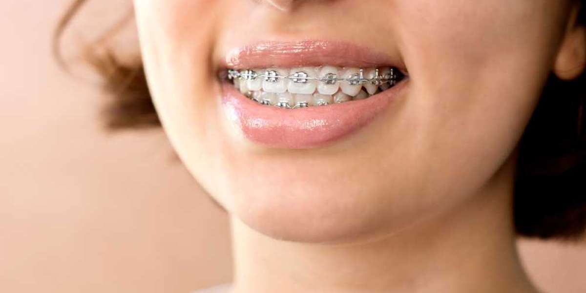 How Effective Are Invisible Braces?