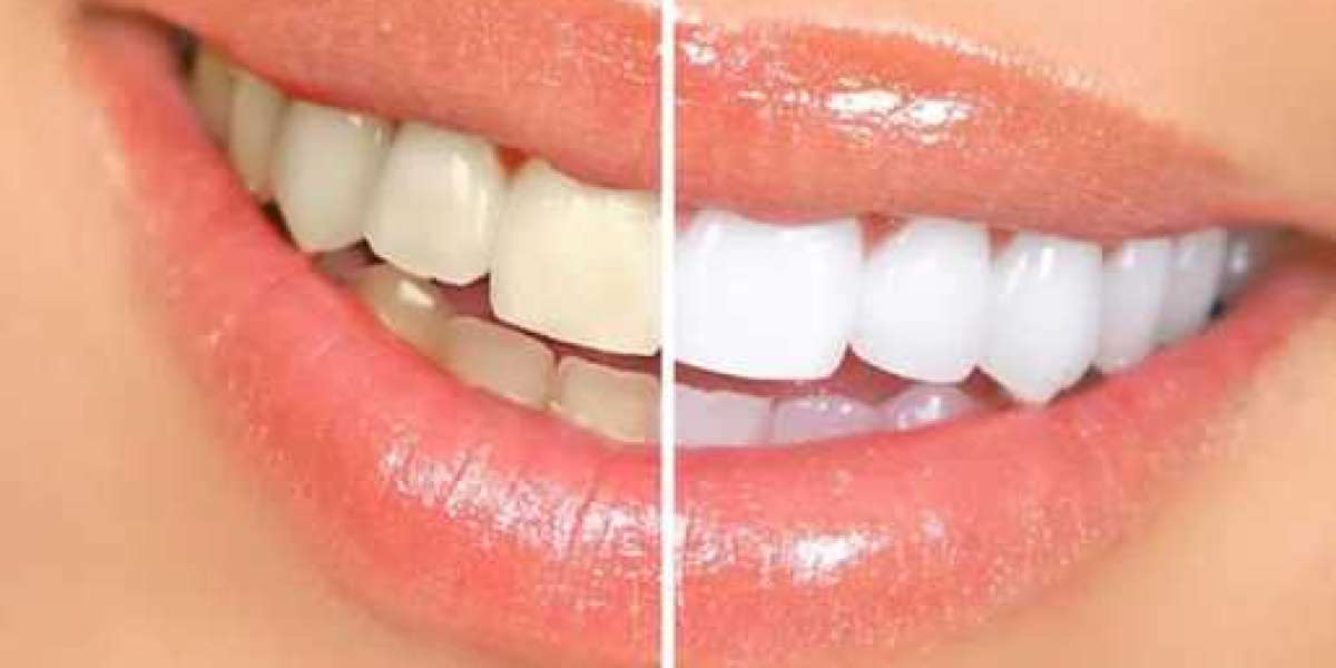 The Advantages of Teeth Whiteners