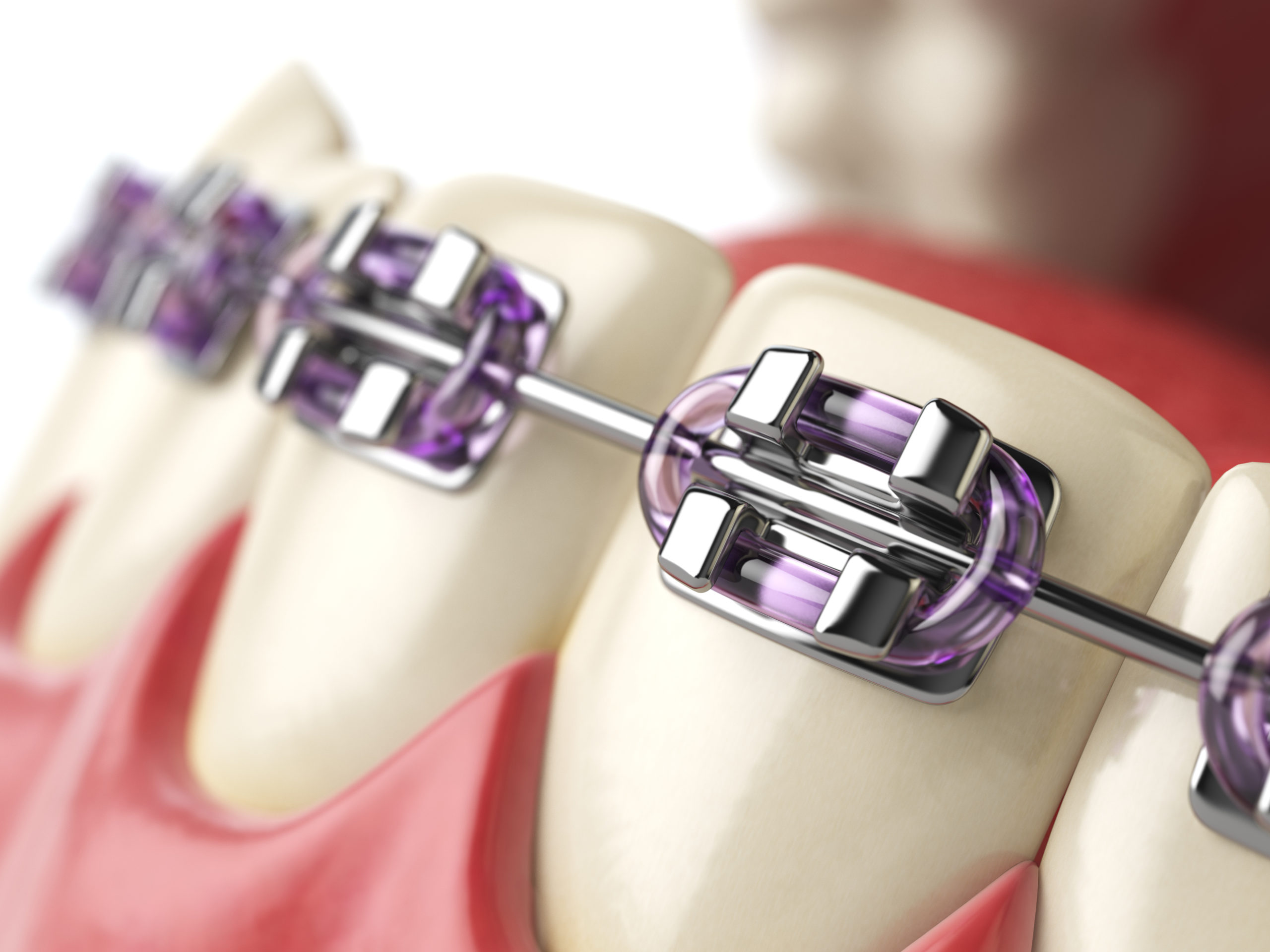 Early Orthodontic Care Avoids Costly Future Treatments | TheAmberPost