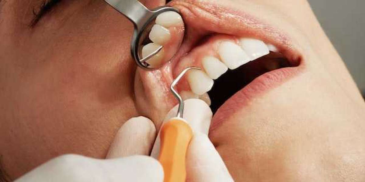 What is a Root Canal Procedure?