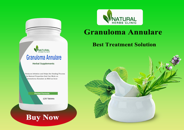 Helpfulness of Granuloma Annulare Different Treatment