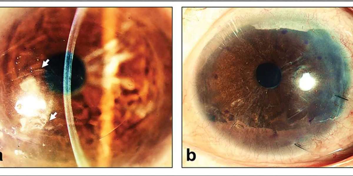 Corneal Endothelial Cell Transplant Market size is expected to grow USD 956.18 million by 2033