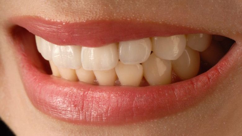 Veneers  Misconceptions about them | Times Square Reporter