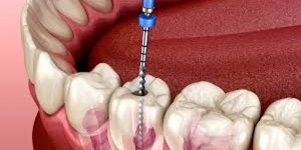 The Evolution of Root Canal Treatment: Past, Present, and Future Perspectives