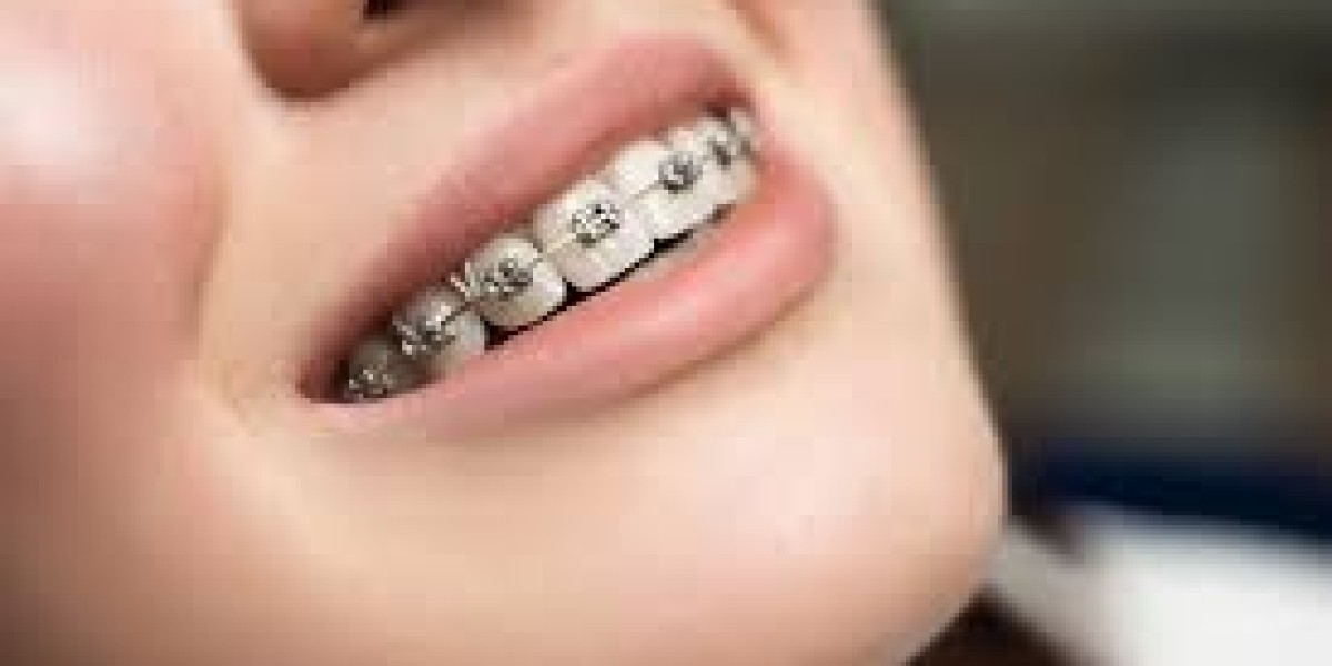 Unlock Your Smile's Brilliance with Metal Braces