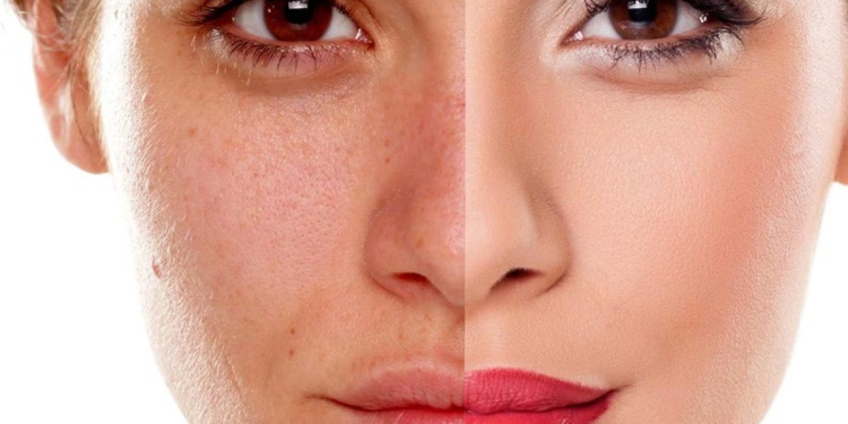 Reveal Your True Beauty: Modern Pigmentation Treatment Approaches