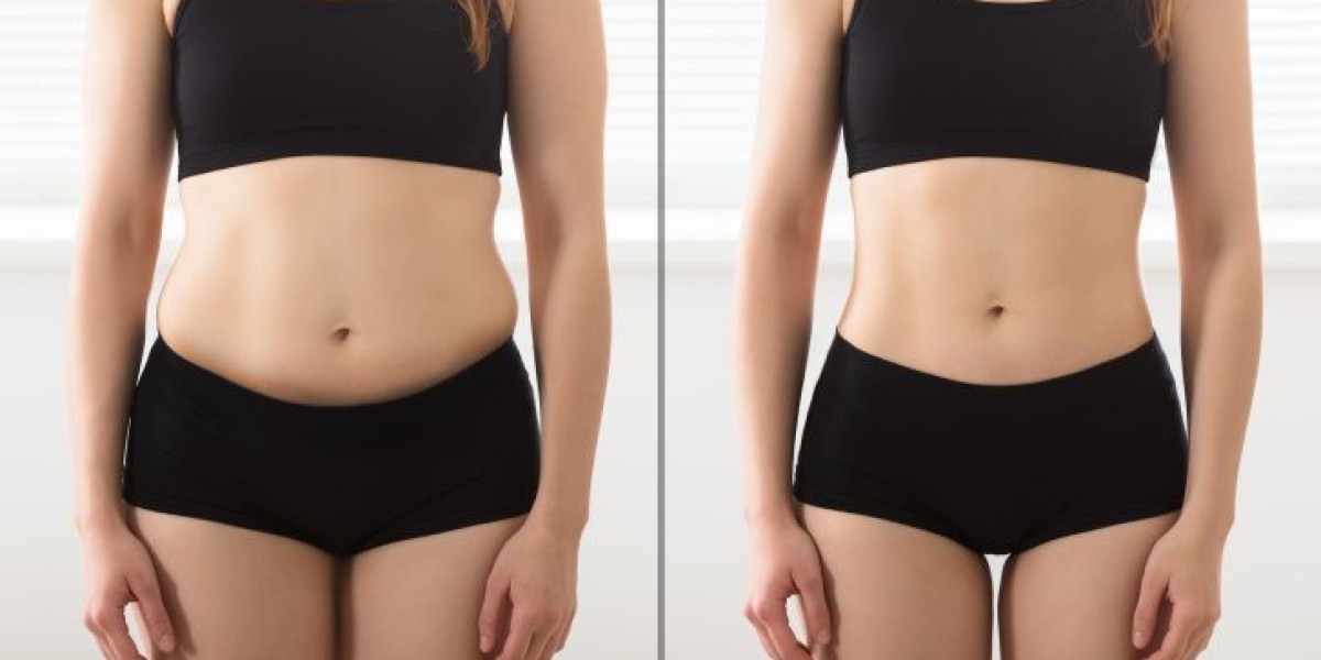 Embody Confidence: Laser Liposuction for a Radiant You