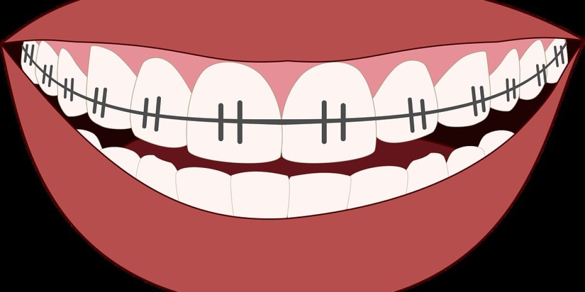 Enhancing Your Smile with Braces in Bella Vista