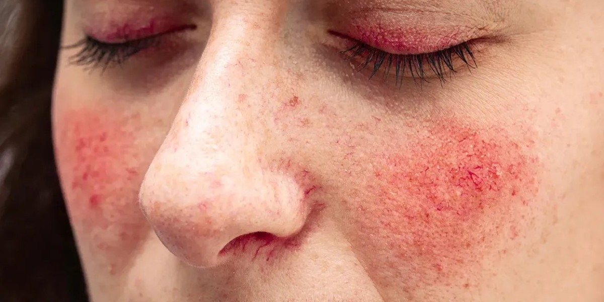 Mastering Rosacea Management: Tips and Tricks