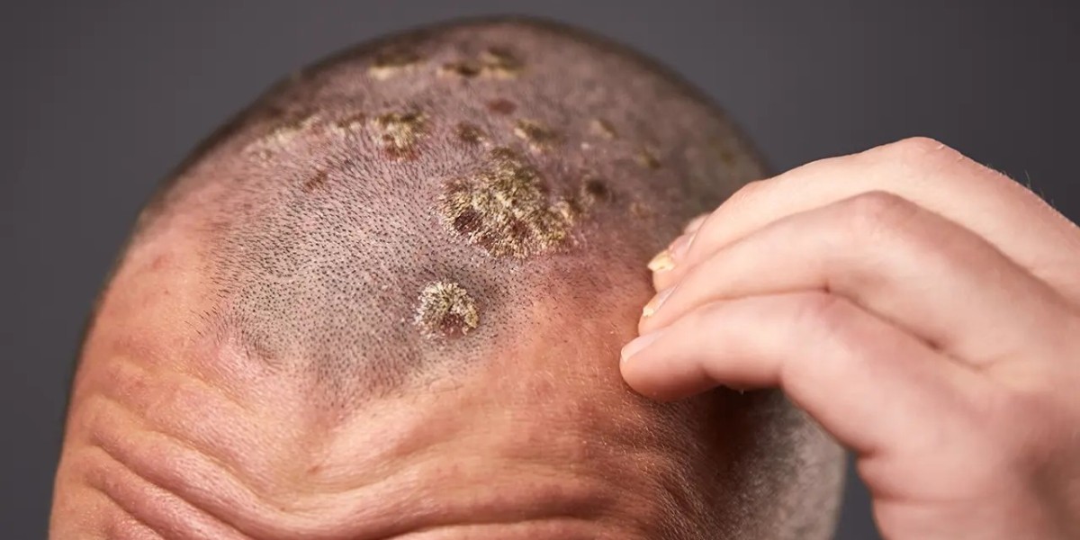 Scalp Psoriasis: Its Symptoms, Causes And Its Treatment Options