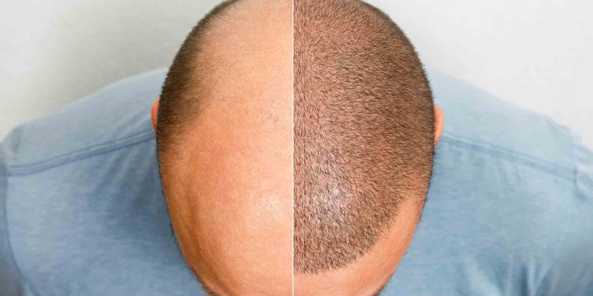 Natural-Looking Results: Scalp Micropigmentation Success Stories
