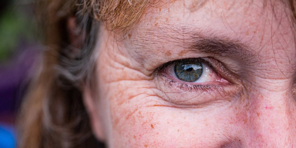 Can Eyelid Surgery OKC Affect Your Eyesight?