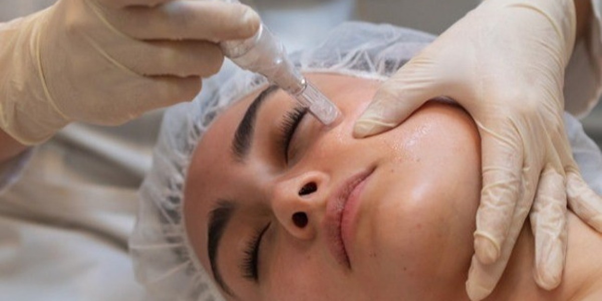 Microneedling for Dark Circles and Under-Eye Bags: The Painless Path to Brighter Eyes