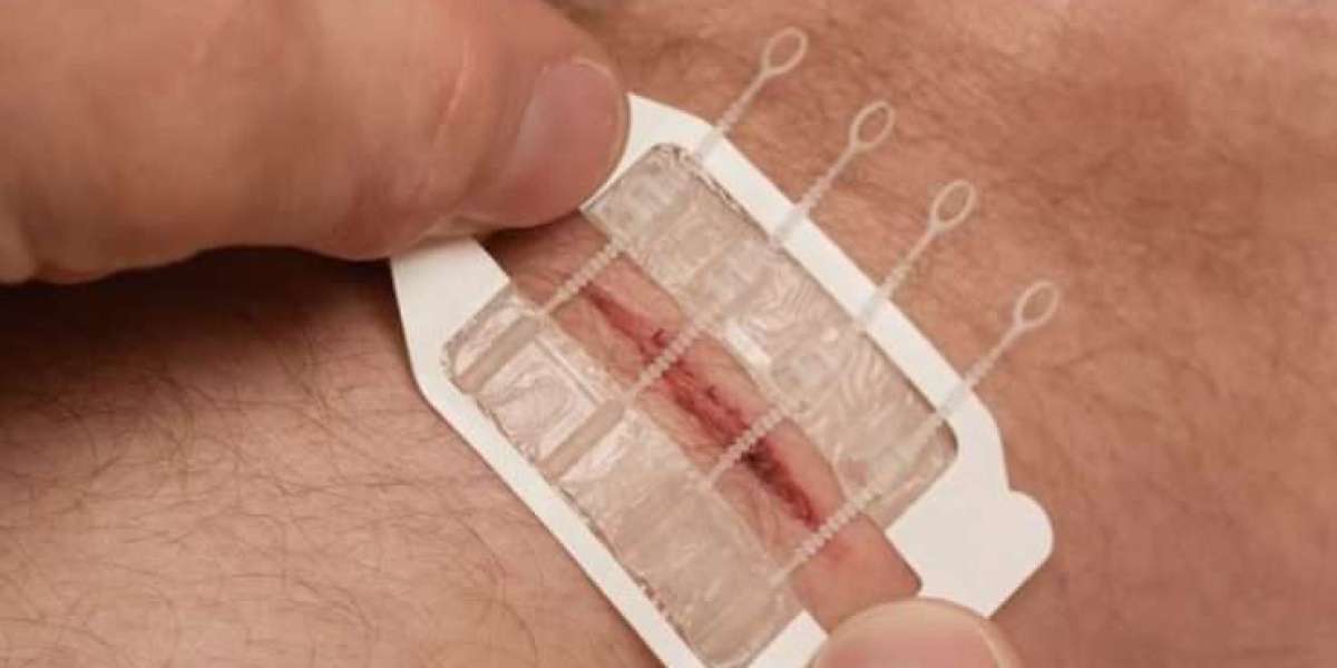 Wound Closure Devices Market Share, Insights and Forecast to 2032