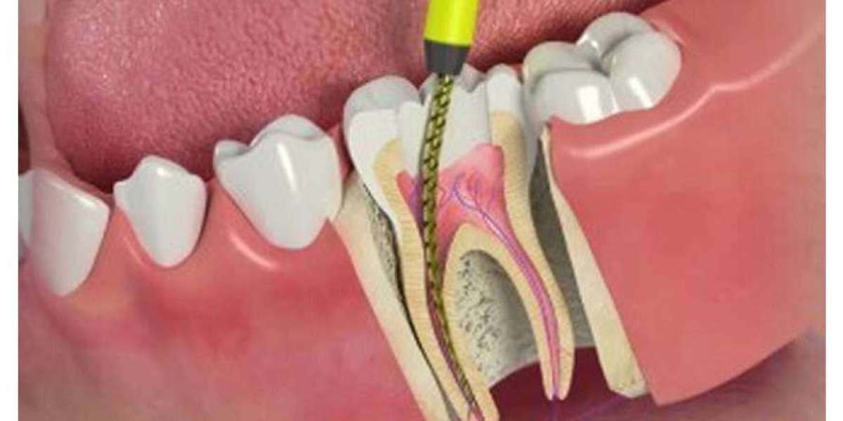 The Science Behind Stress-Free Root Canals