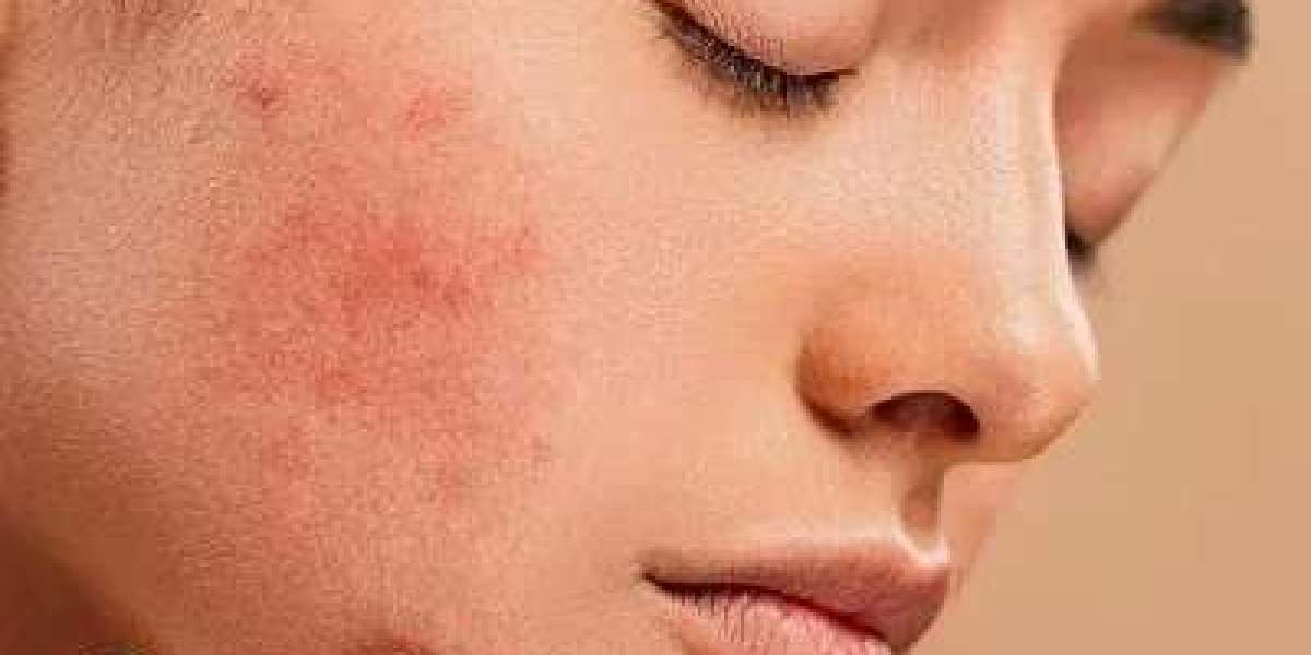 Home Remedies for Acne: Do They Work?