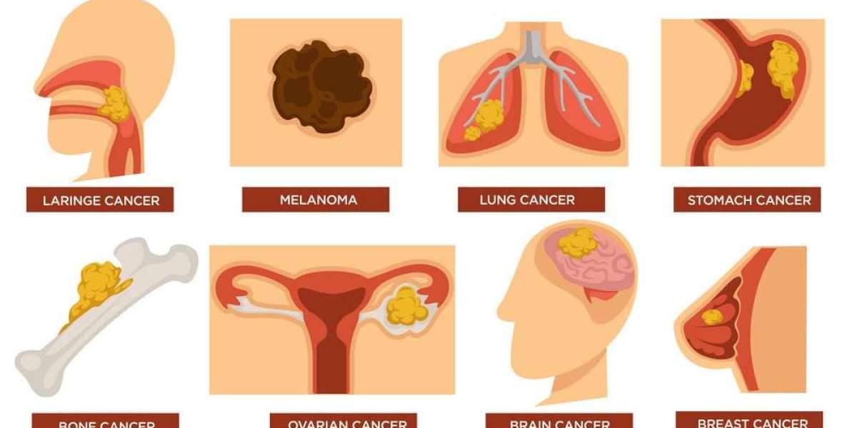 A Comprehensive Guide to Different Types of Cancer and Their Varied Treatment Approaches