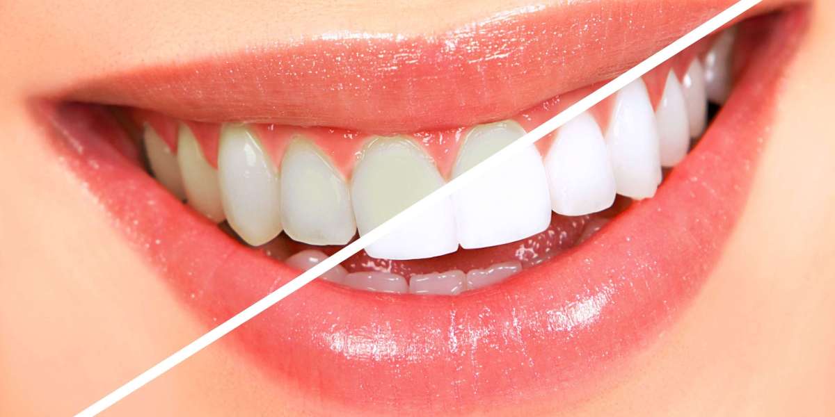 Overcoming Teeth Stains: Causes and Solutions