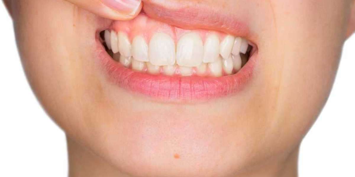 The Role of Oral Hygiene in Gum Recession Management