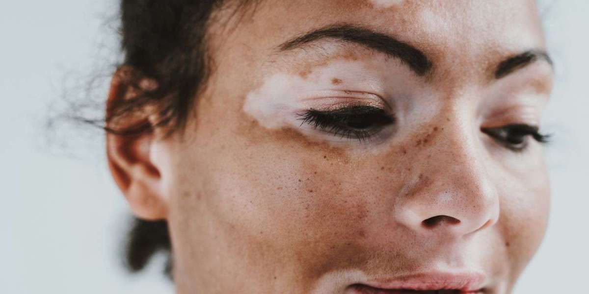 can vitiligo be cured at early stage