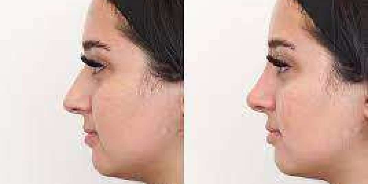 Rhinoplasty in Antalya Your Journey to a New Nose