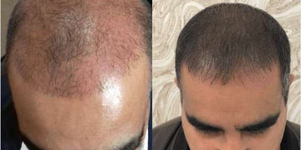 How Does Shaveless FUE Hair Transplant Work for Complete Hair Solution