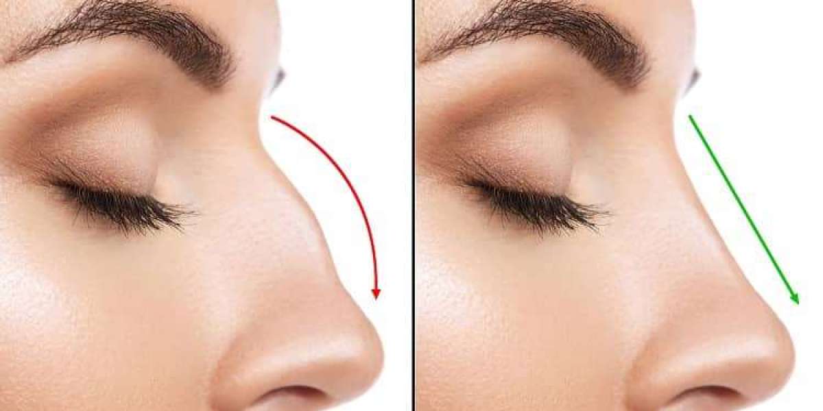 Dubai's Nose Job Paradise: Sculpting Your Ideal Facial Harmony