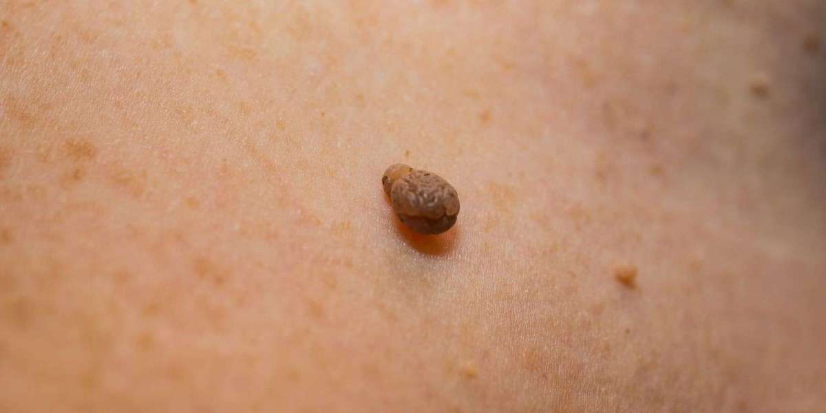 "Skin Tag Removal 101: A Comprehensive Guide"