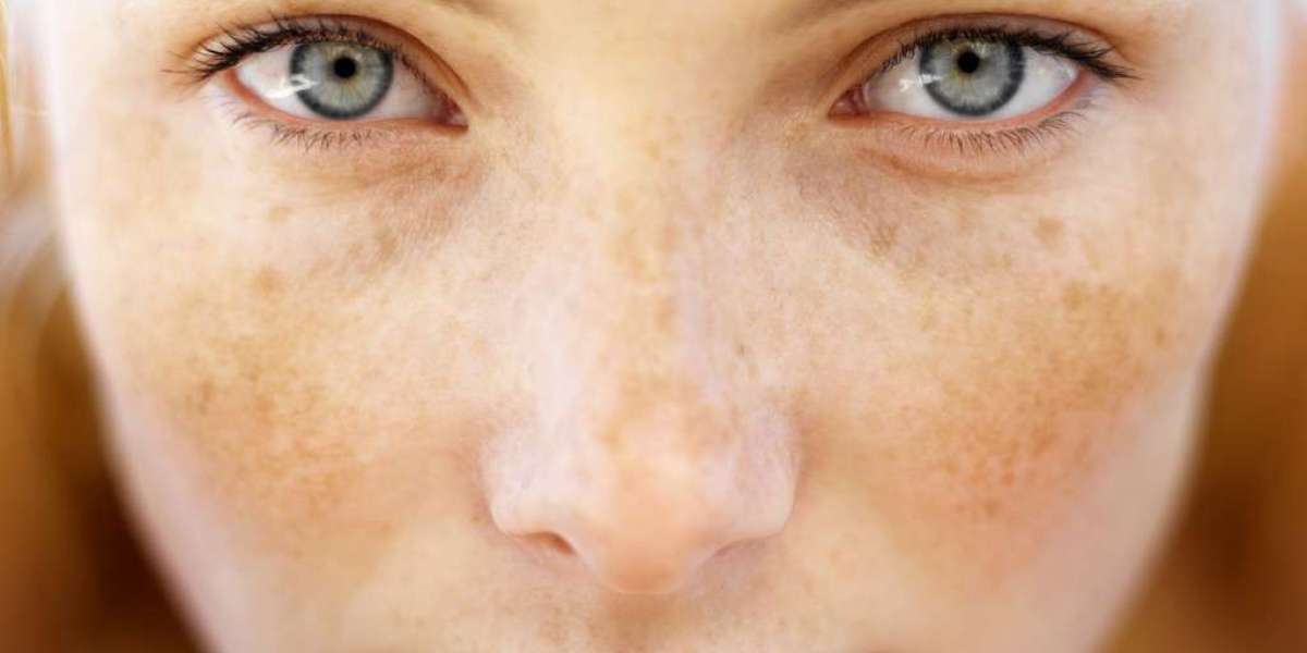 Freckles Unveiled: Redefining the Beauty Norm