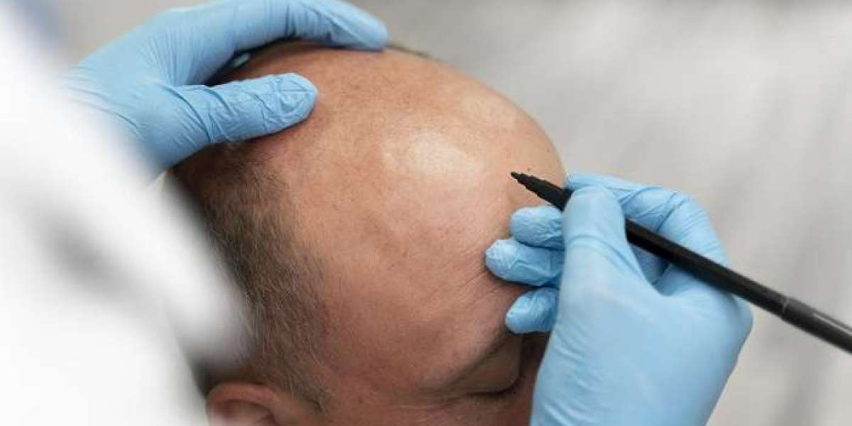 From AED to Confidence: Unraveling Hair Transplant Costs in Dubai