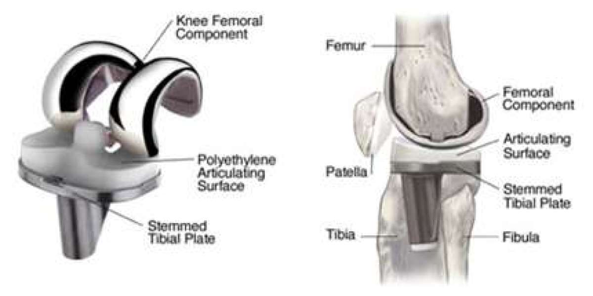 High Flex Knee Replacement