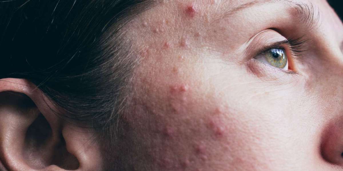 Dubai Dermatosis Chronicles: Insights into Common Skin Afflictions