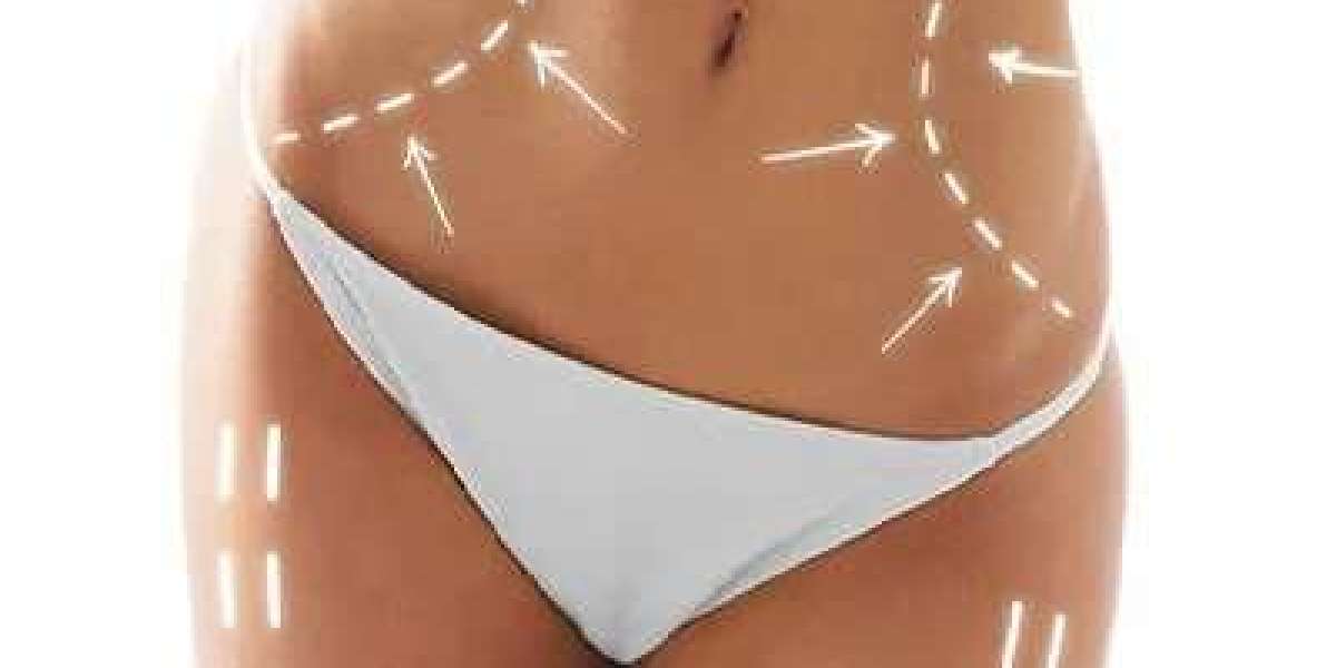 Exploring the Latest Advancements in Laser Liposuction Technology