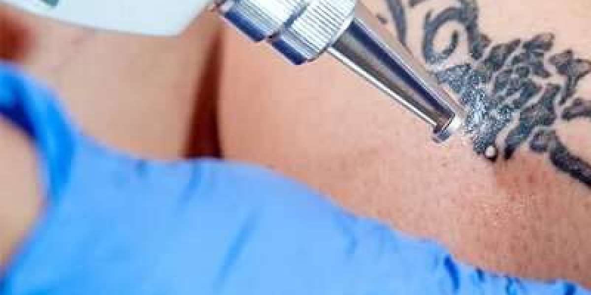 Tattoo Removal and Skin Health: What You Need to Know