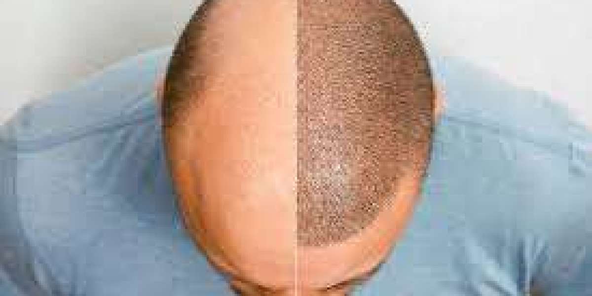 he Ultimate Guide to Successful Hair Transplants