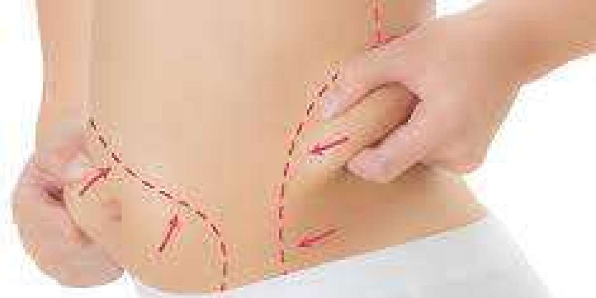 Liposuction Surgery in Dubai: Reshaping Confidence in the Oasis of Luxury