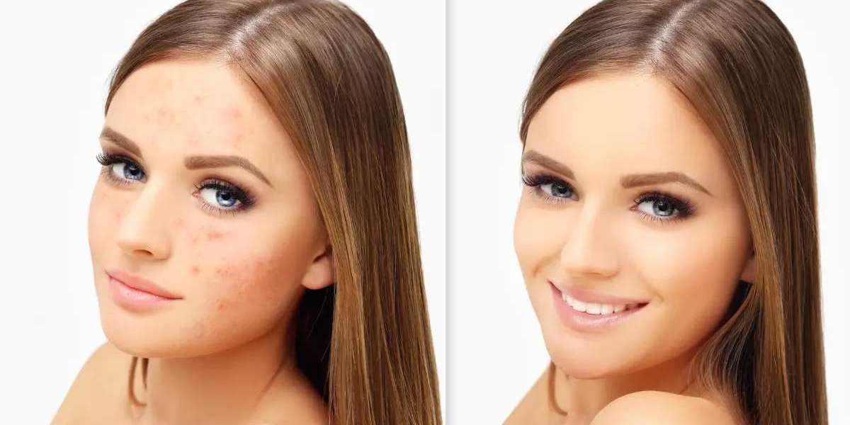 The Journey to Clear Complexion: Acne Scars Treatment in Dubai