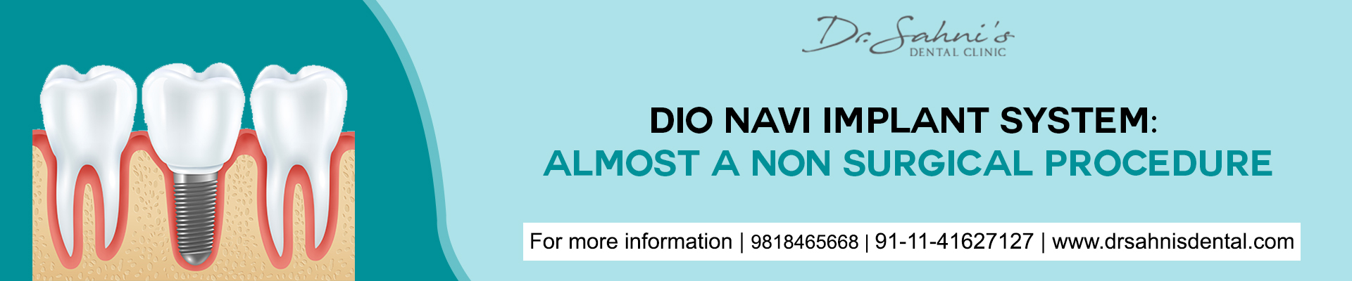 DIO Navi Implant System: A Nearly Non-Surgical Procedure - Drsahnisdental Blogs