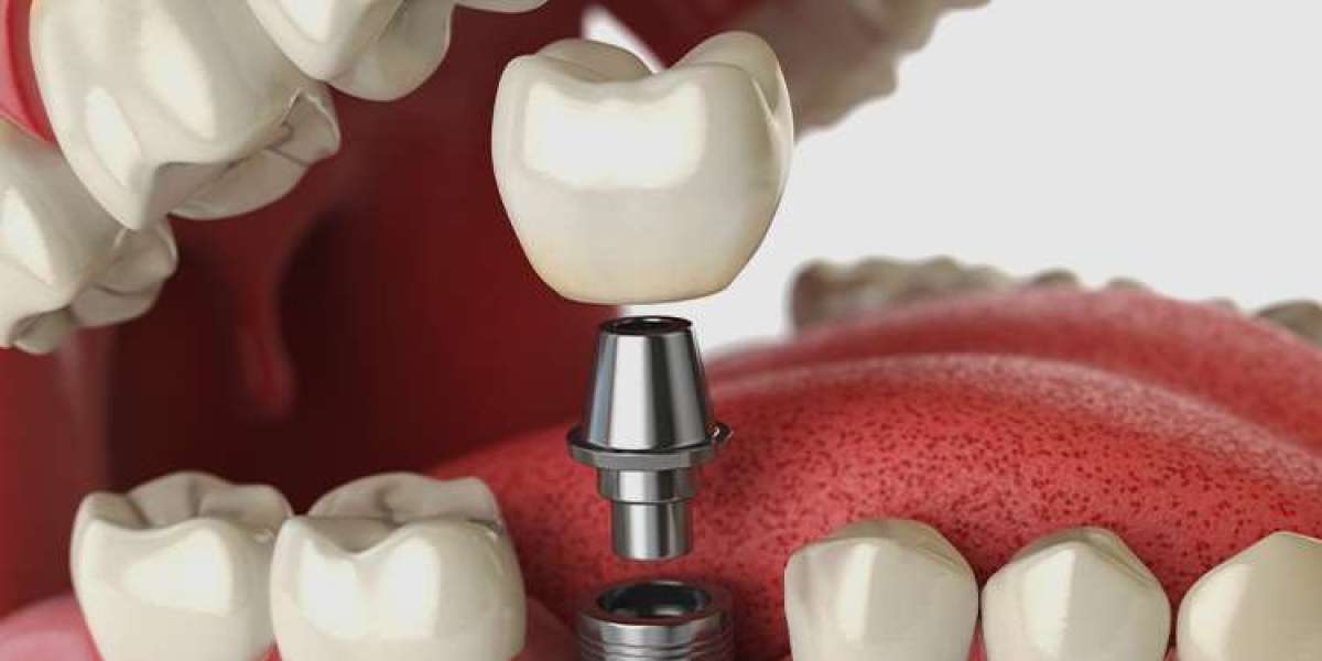The Evolution of Dental Implants: From Concept to Cutting-Edge Technology