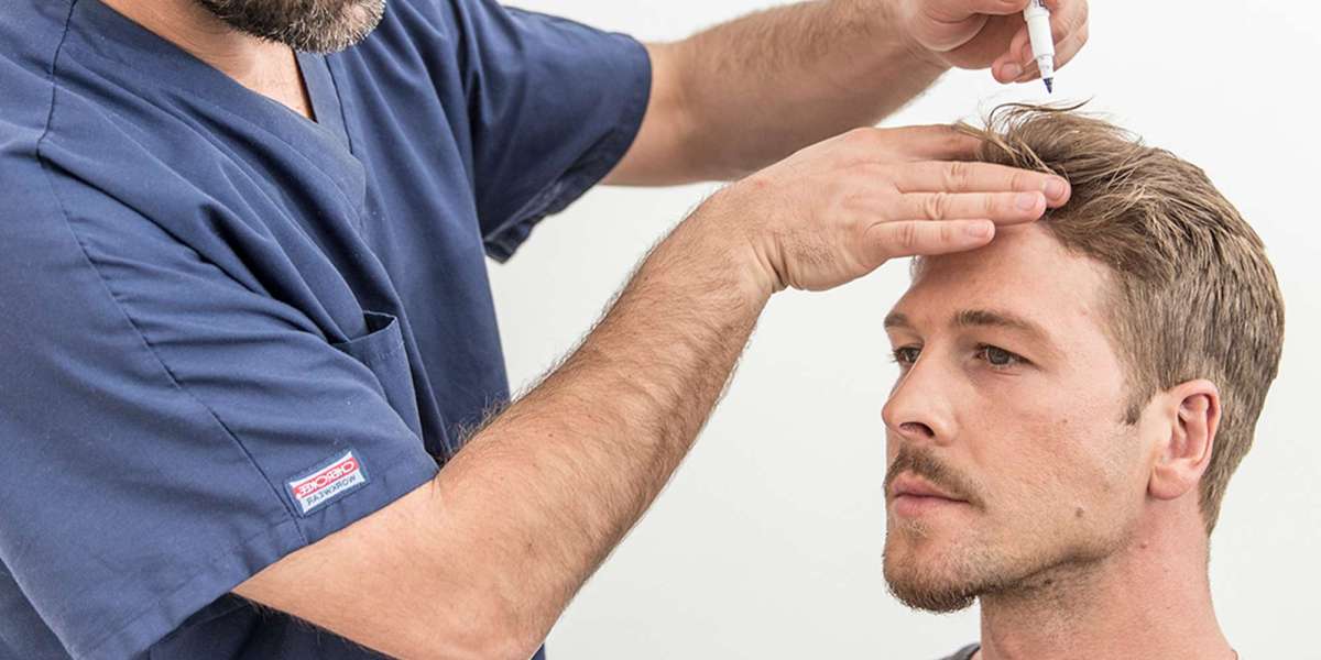 Unlocking Self-Assurance: Everything You Need to Know About Hair Restoration in Riyadh