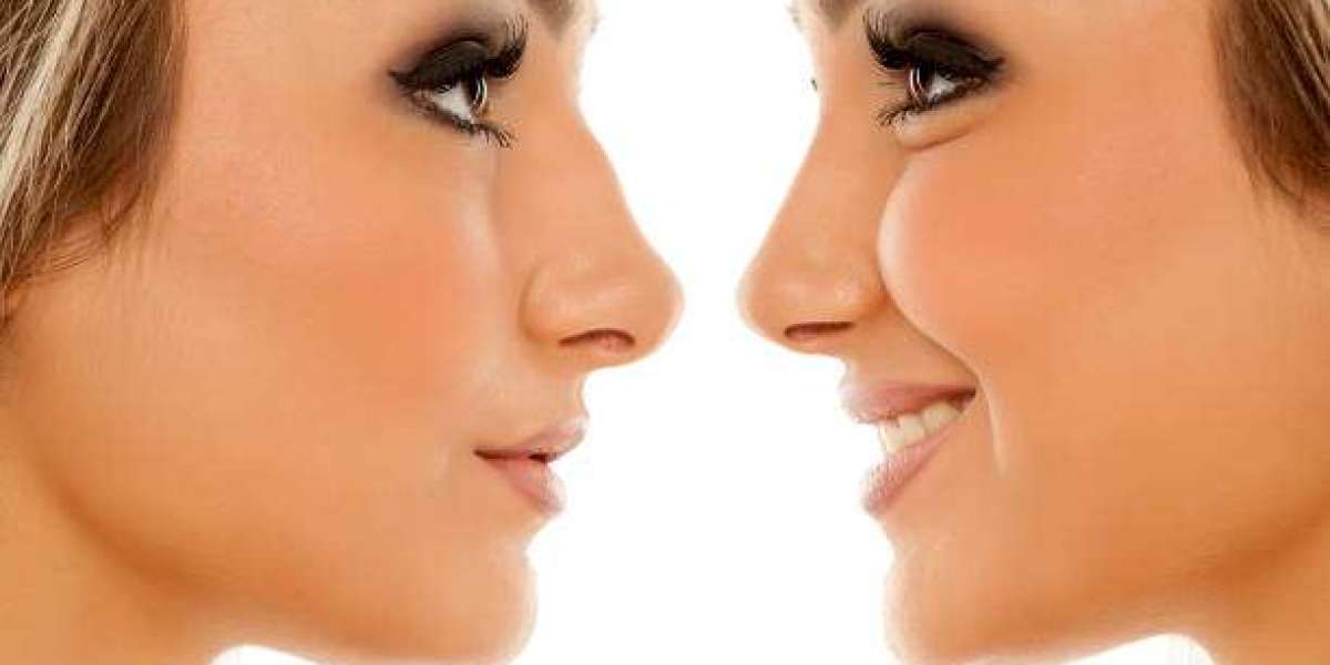 Dubai's Rhinoplasty Revolution: Breaking Stereotypes and Building Confidence