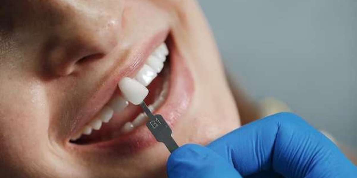 Turkish Delight: A Complete Guide to Dental Veneers in Turkey