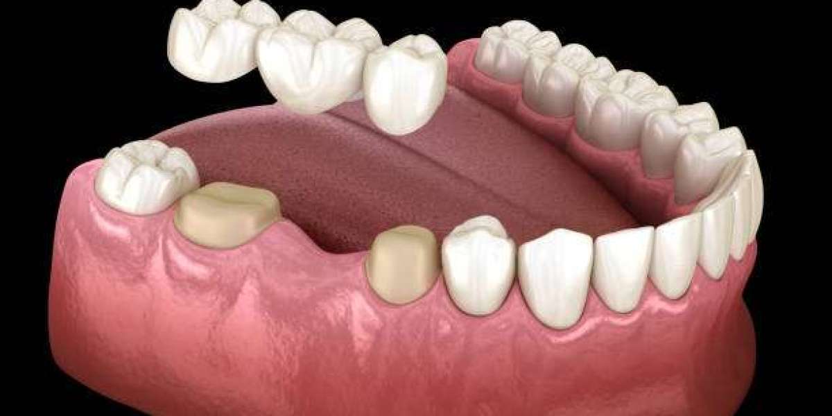 Affordable Smiles Await: Dental Bridge Cost in Abu Dhabi