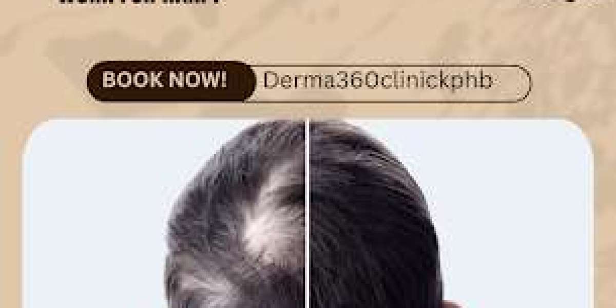 Derma 360: Pioneering Dermatology Solutions for Hair Fall and Acne Treatment in Kukatpally