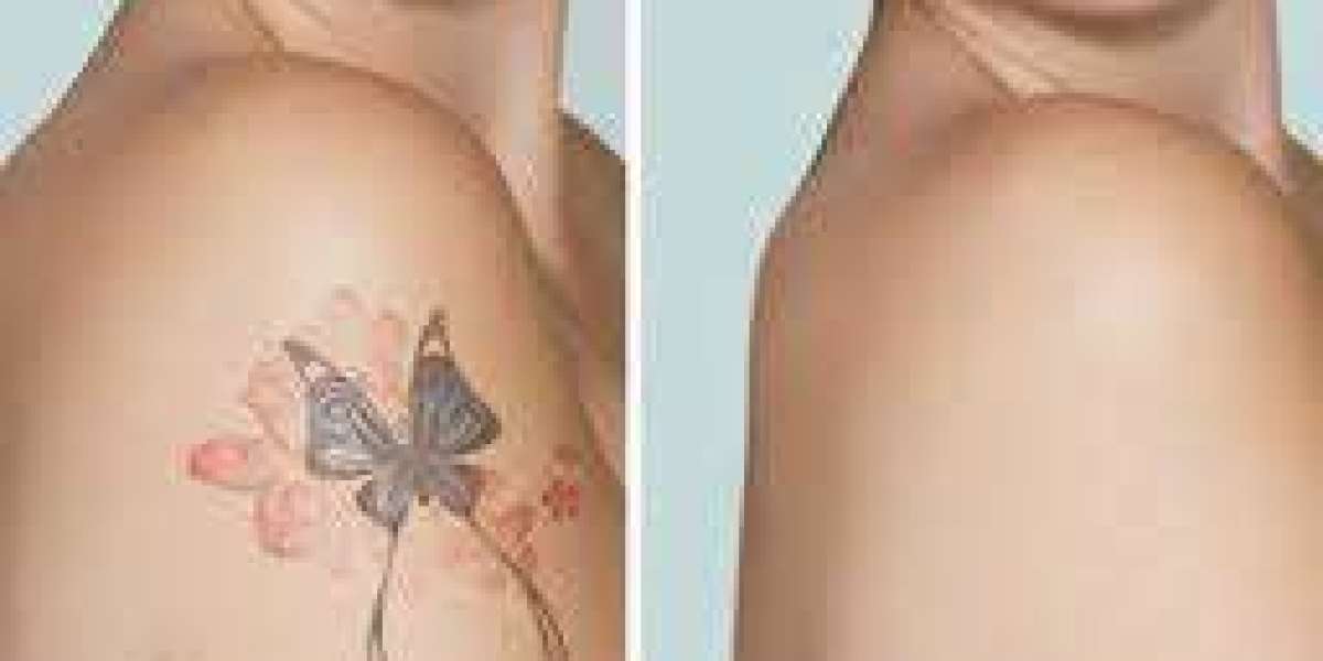 Evolving Elegance: Laser Tattoo Removal in Dubai