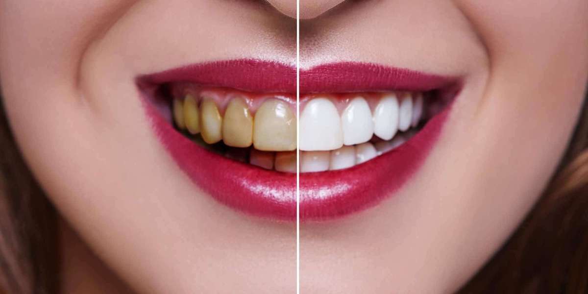 Teeth Whitening 101: What Dubai Residents Need to Know for a Sparkling Smile