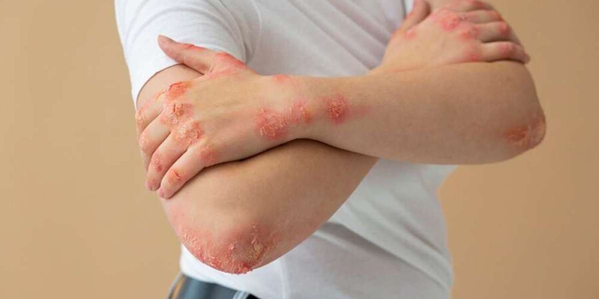 Finding Relief: Can Homeopathy Treat Skin Allergies Effectively?