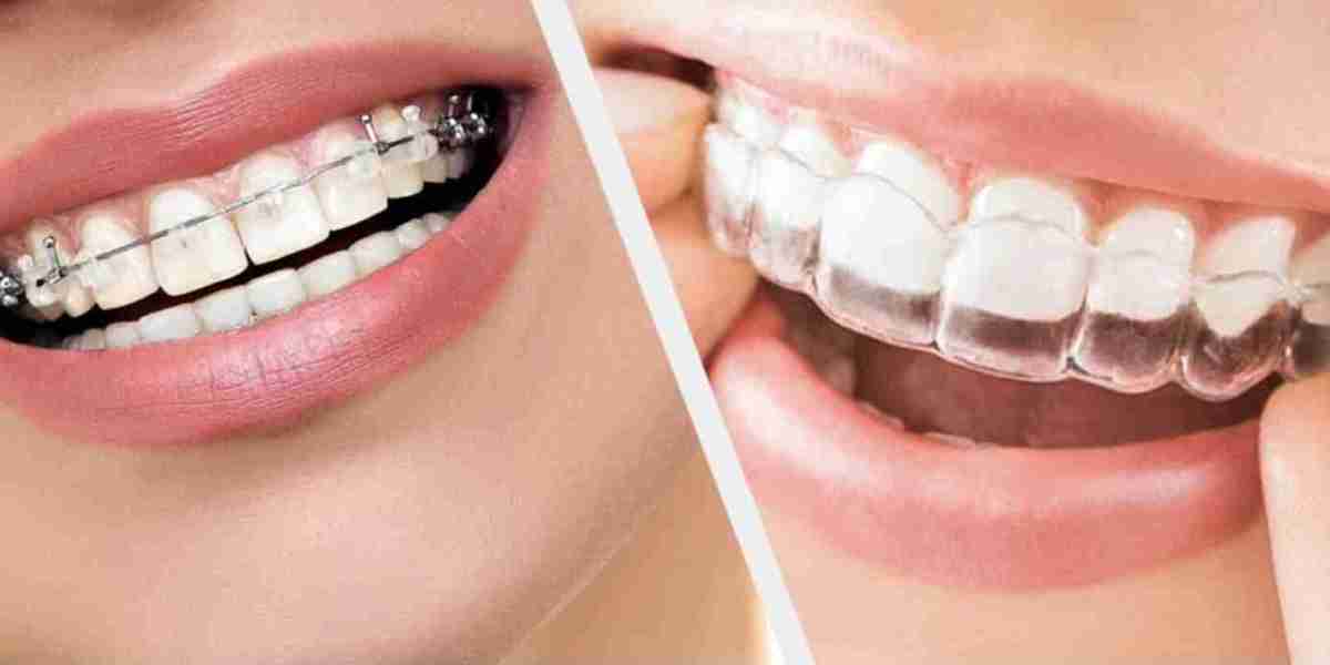 Lingual Braces vs. Traditional Braces: Which is Better?