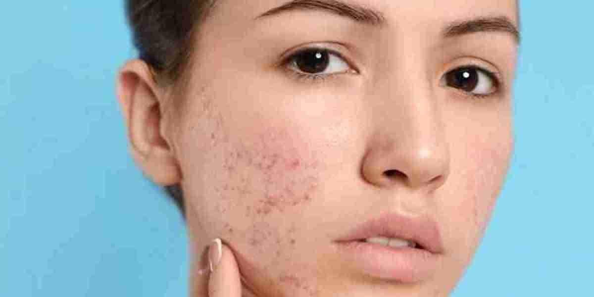 Blemish-Free Beauty Riyadh's Top Picks for Acne Scar Treatments